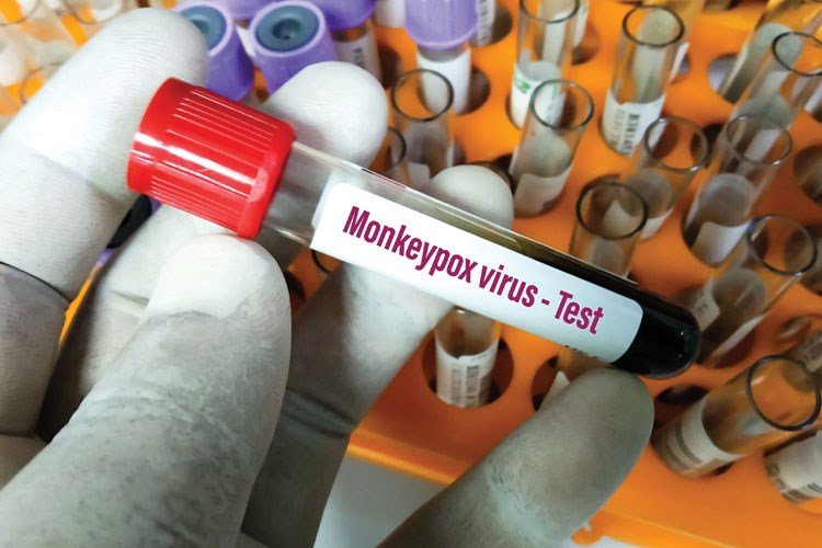 Bakıda özəl klinikalarda meymunçiçəyi testlərinə başlanılır